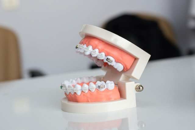 Read more about the article First Week With braces? Here are 10 Crucial Tips Which You Must Know!